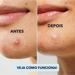 curativo-hidrocoloide-para-acnes-e-espinhas-cremer-24-unidades-detalhes